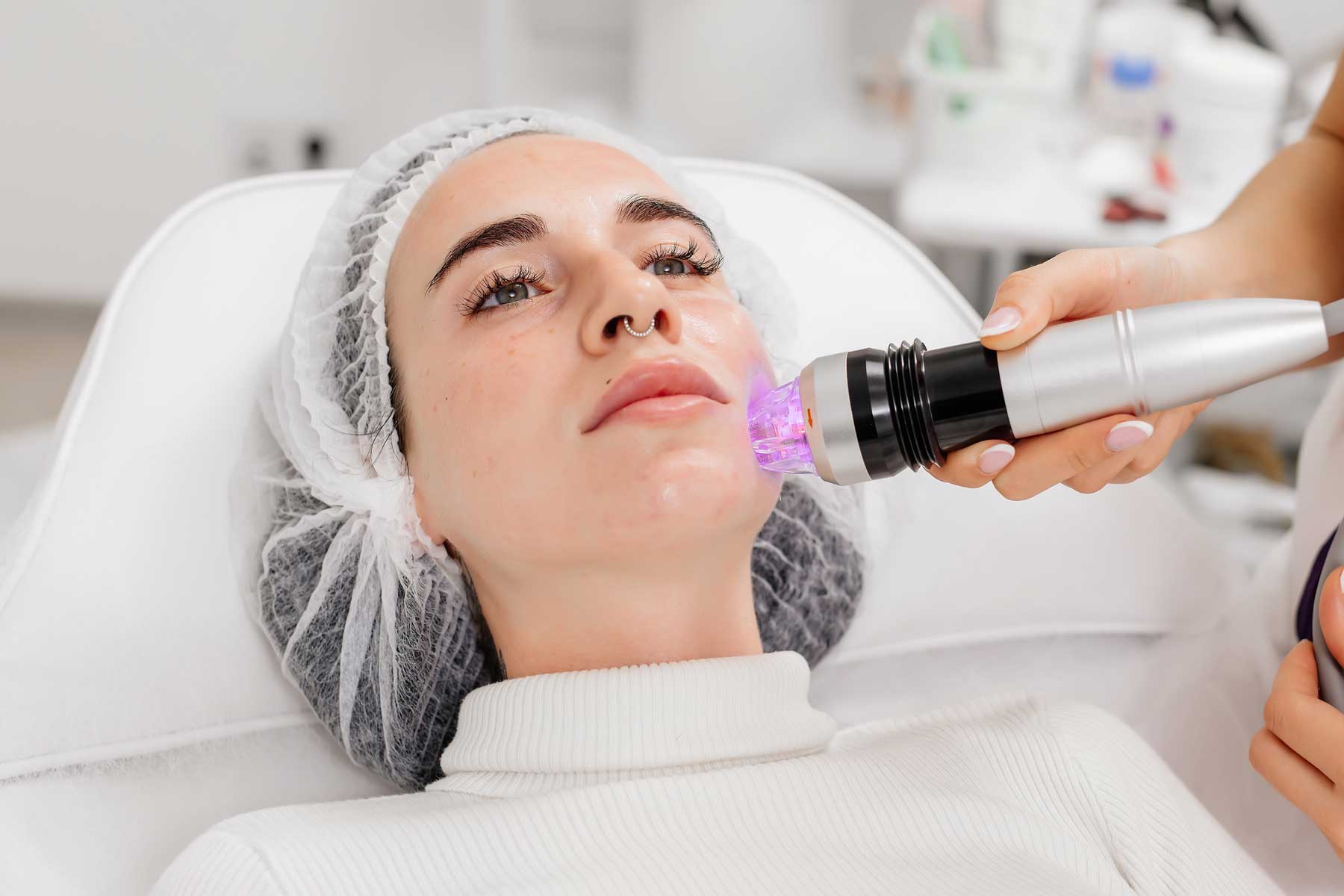 A woman getting an RF microneedling treatment on her facial skin A woman getting an RF microneedling treatment on her facial skin