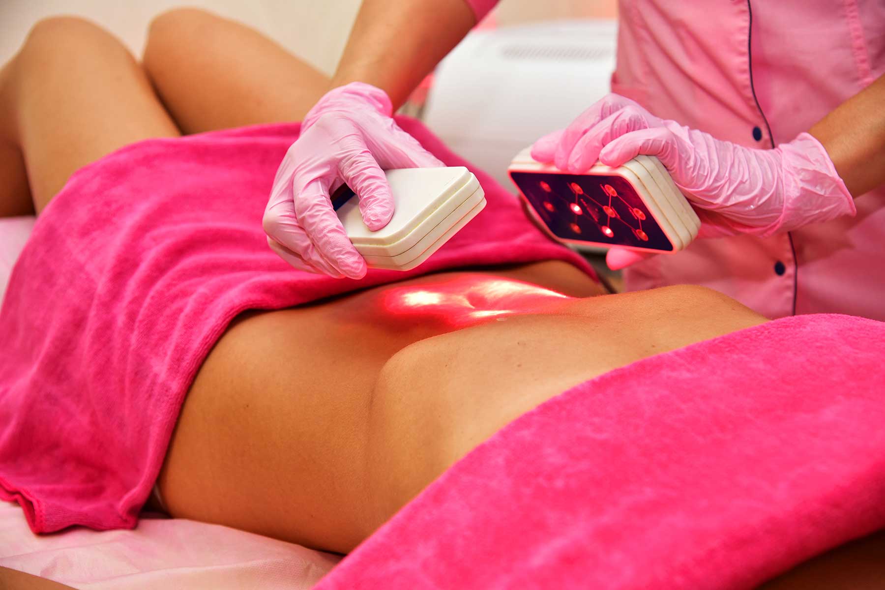  Close-up view of a laser lipo treatment applied to the abdomen of a client